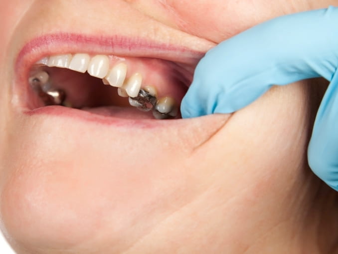 symptoms of mercury poisoning from fillings